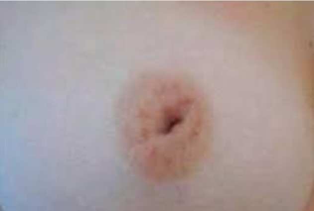 乳頭凹陷