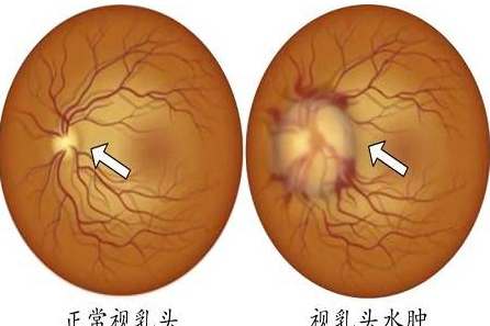 乳頭水腫