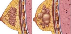 乳房穿刺活檢後注意事項