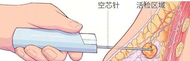 乳房穿刺