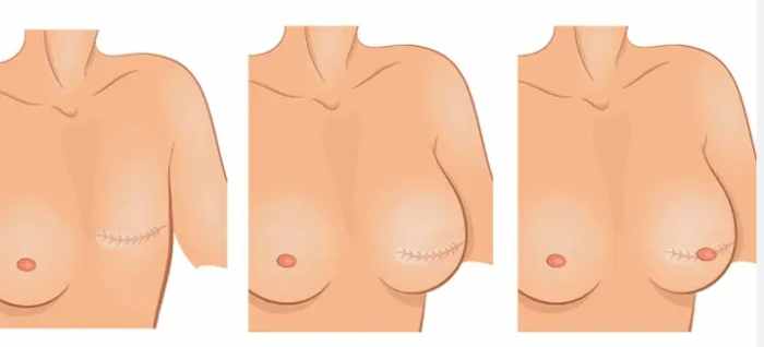 乳房重建手術