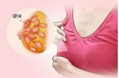 乳房 硬塊