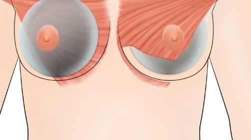 果凍矽膠隆乳後遺症 果凍矽膠隆乳後遺症
