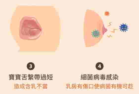 乳頭痛的原因