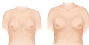 水滴型隆乳價格