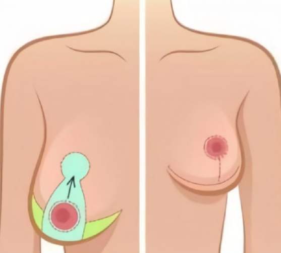 水滴隆乳手术方式