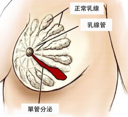 如何判斷乳頭分泌物異常