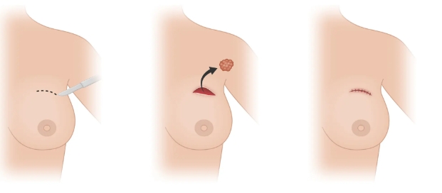 乳房腫瘤良性 乳房腫瘤良性