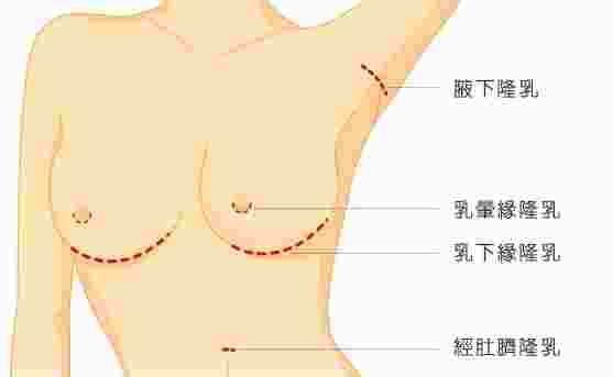 水滴隆乳全解析