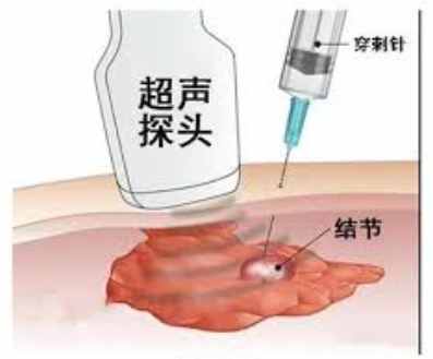 乳房穿刺檢查
