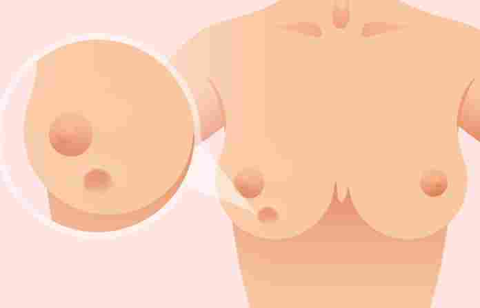 乳房 凹陷