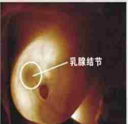 乳房結節種類