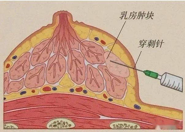 乳房穿刺的類型