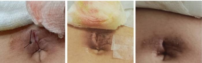 水滴型隆乳術後照顧