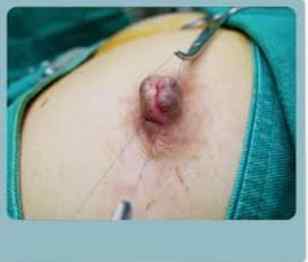 乳頭凹陷手術