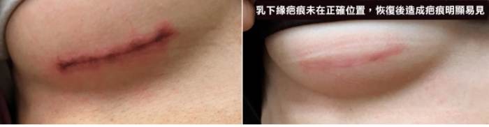 水滴型隆乳價格
