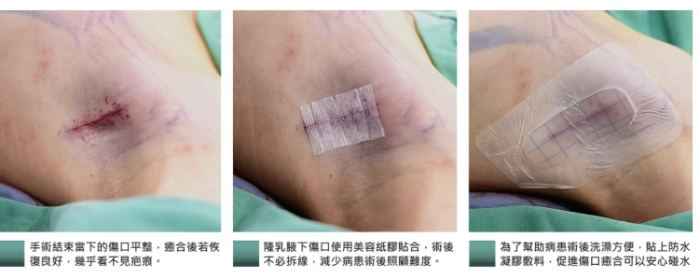 水滴隆乳手术方式