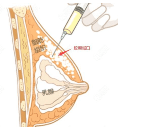 隆 乳 後遺症