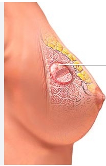 乳房腫瘤治疗 乳房腫瘤治疗