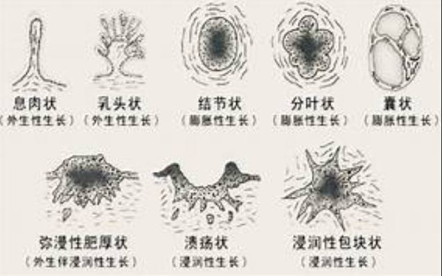 乳腺結節良性