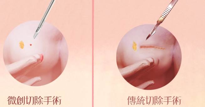 乳房水泡預防方法