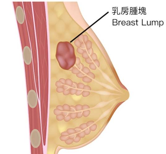 乳房 腫瘤