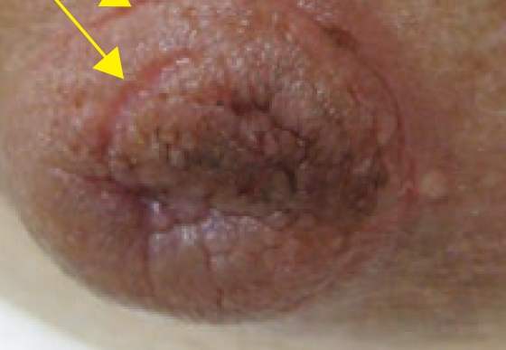 親餵乳頭常見的傷害