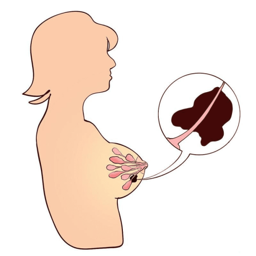 乳房鈣化點切除手術