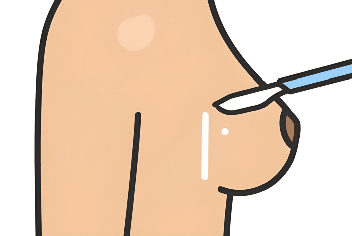 自體脂肪隆乳費用 自體脂肪隆乳費用