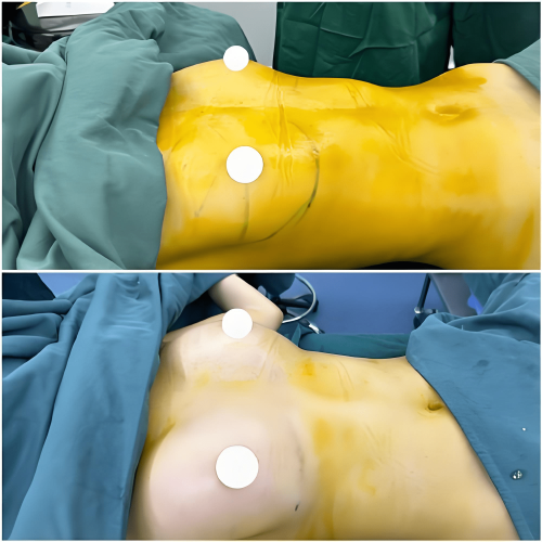 自體脂肪隆乳術後保養 自體脂肪隆乳術後保養