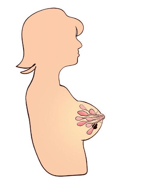 如何防止乳房不適症