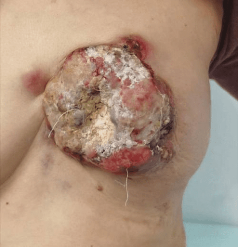 乳癌症狀