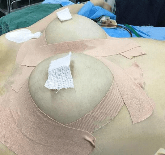  隆乳術原理