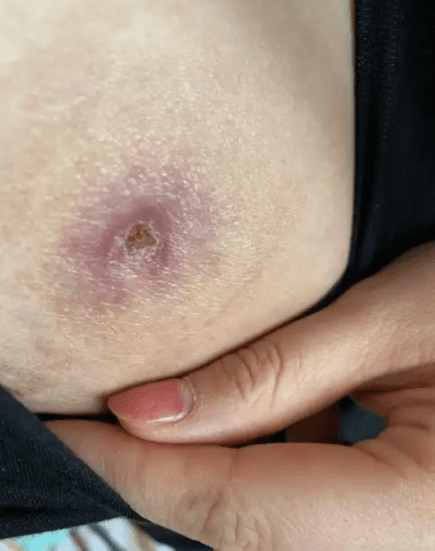 乳腺炎症狀 乳腺炎症狀