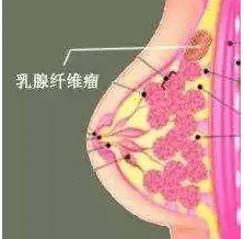 纖維瘤手術 纖維瘤手術