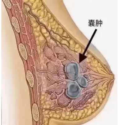 乳房纖維囊腫
