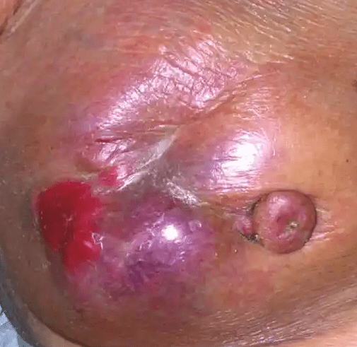 乳腺炎症狀發燒 乳腺炎症狀發燒