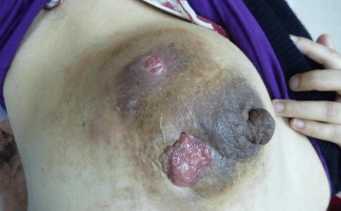 乳腺炎症狀非泌乳期 乳腺炎症狀非泌乳期