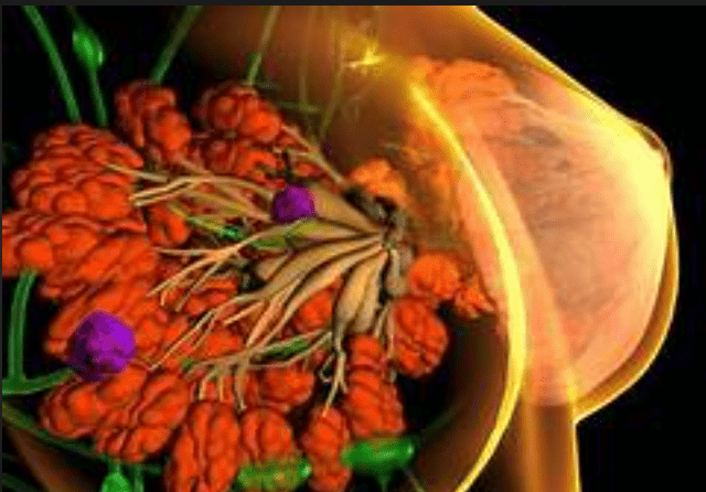 纖維腺瘤原因 纖維腺瘤原因