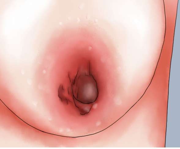 乳頭小白點