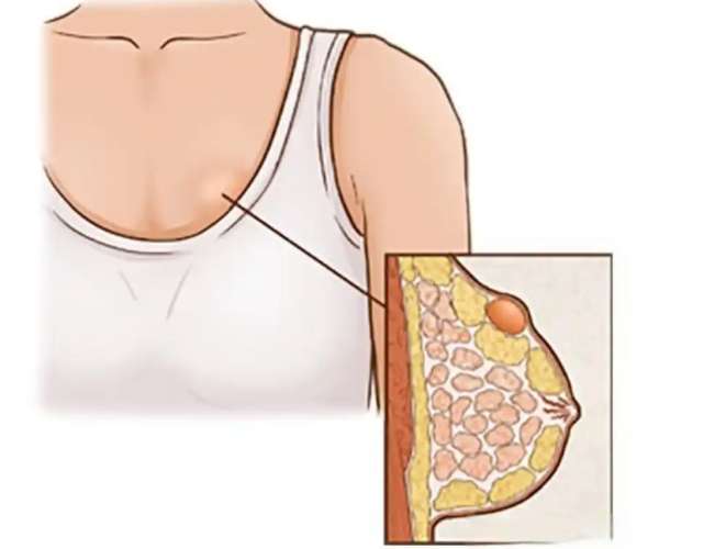 乳房硬塊會痛 乳房硬塊會痛