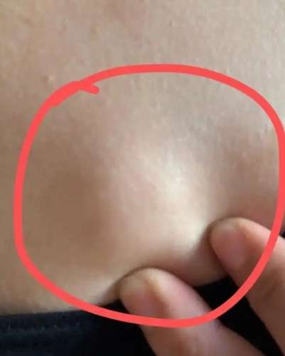 乳房硬塊如何處理 乳房硬塊如何處理
