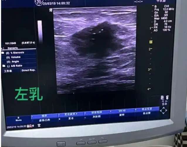 乳房超音波 乳房超音波