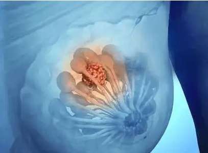 乳腺增生治療 乳腺增生治療