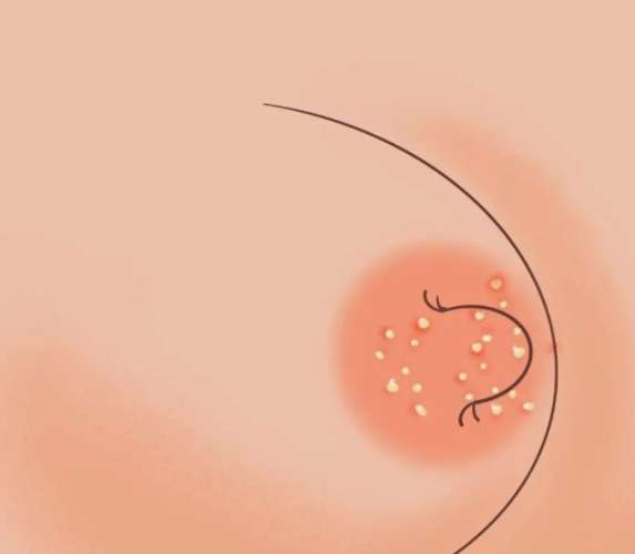如何避免乳頭小白點再次發生 如何避免乳頭小白點再次發生