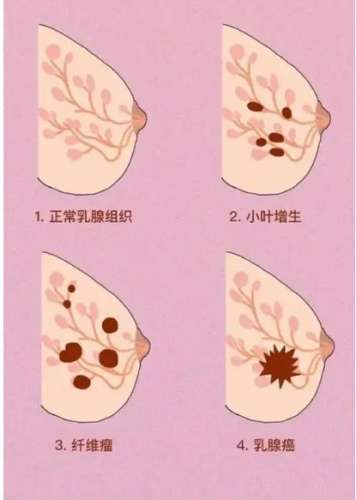 乳腺增生症狀 乳腺增生症狀