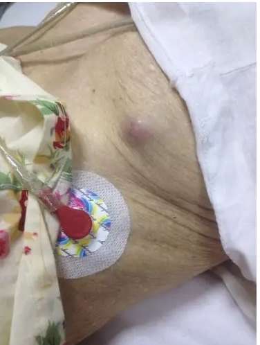 乳房硬塊 乳房硬塊