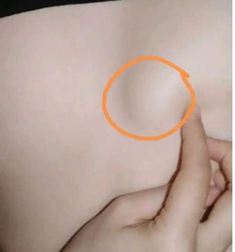 乳房硬塊 乳房硬塊