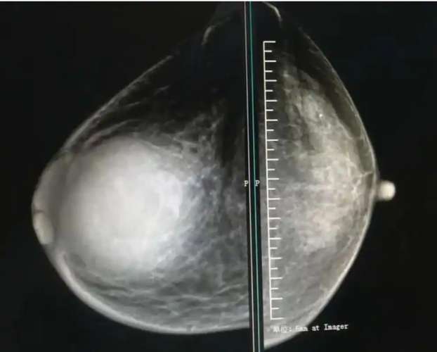 乳房有硬塊是正常的嗎 乳房有硬塊是正常的嗎