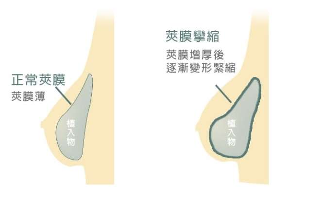 莢膜攣縮症狀 莢膜攣縮症狀